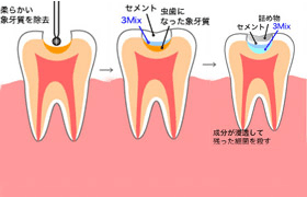 負担の少ない虫歯治療「3mix法」